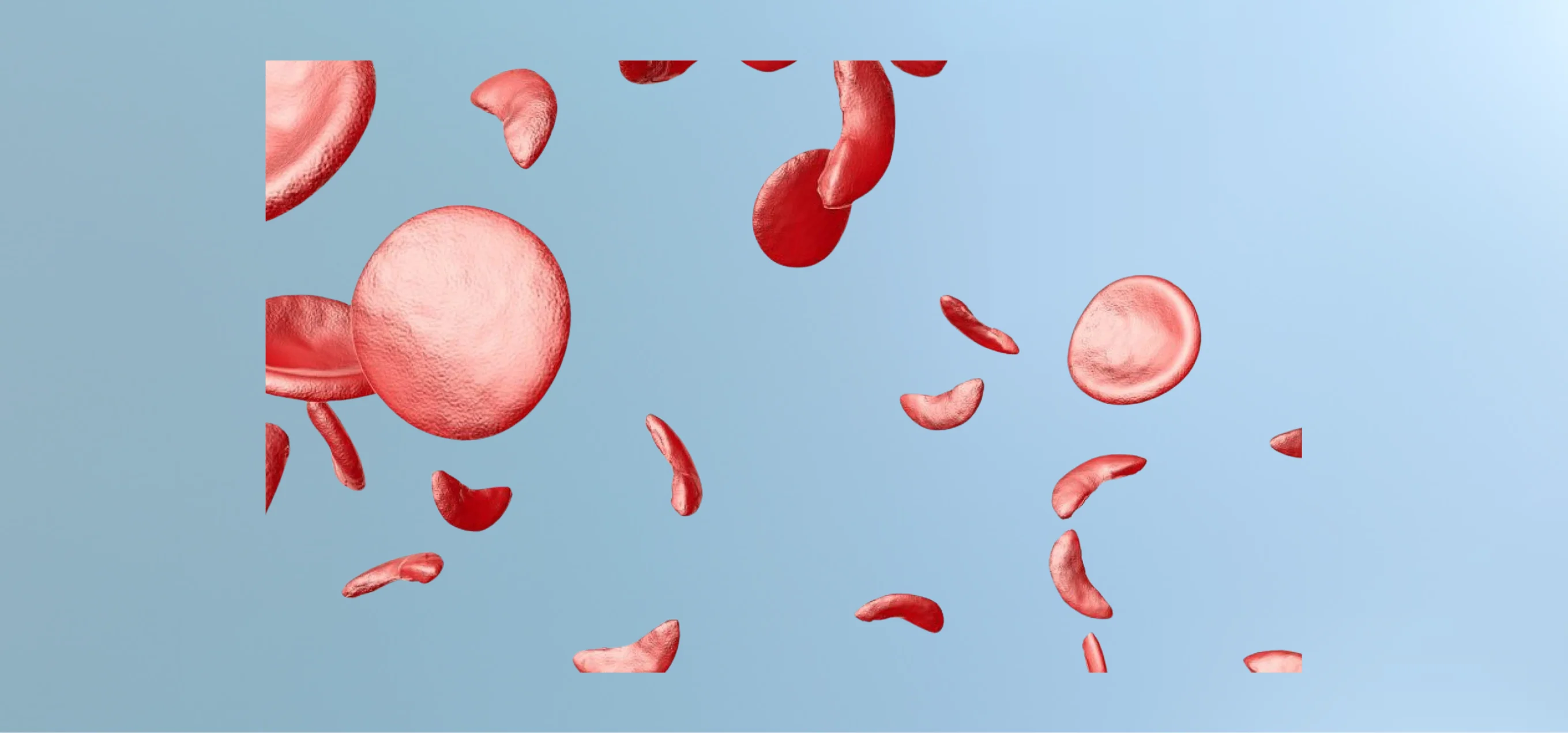 Sickle cell disease treatment by Dr. G. Stitha Pragna in Hyderabad